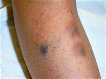 Idiopathic thrombocytopenic Purpura, ITP