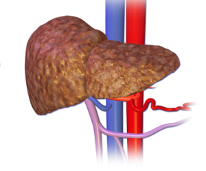 Best Diet Plan for Liver Cirrhosis Patients