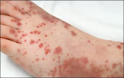 Causes of Idiopathic Thrombocytopenic Purpura (ITP)