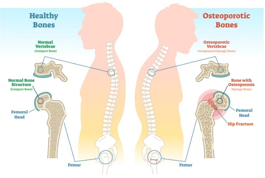 Fisiopatologia De Osteoporosis