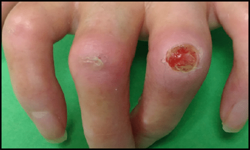 Scleroderma