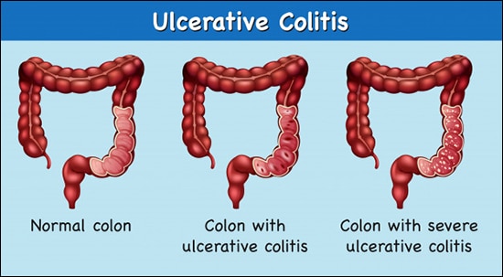 Use of Basti in The Management of Ulcerative Colitis