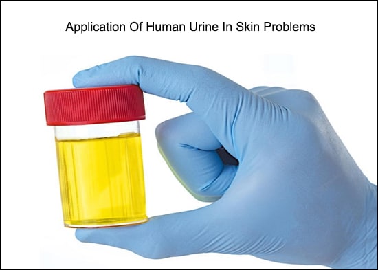 Human Urine In Skin Problems