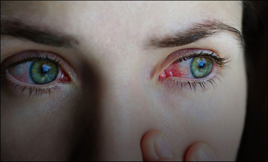 Conjunctivitis (Pink Eye)