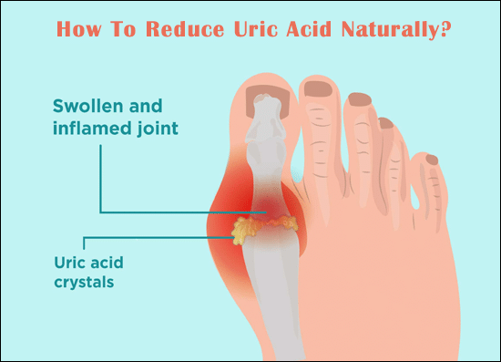 How To Reduce Uric Acid Naturally and Manage Gout