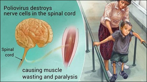 Post Polio Syndrome