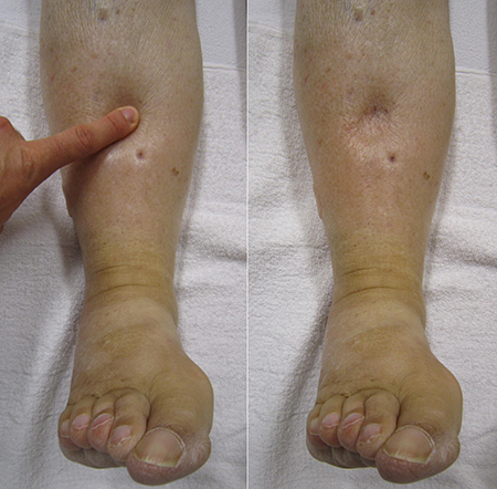 edema, water retention