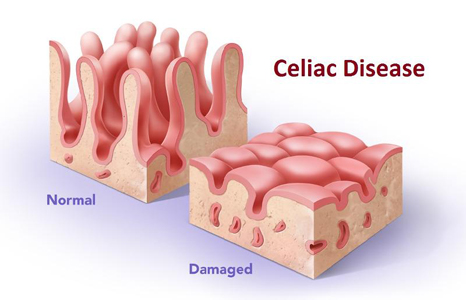 Celiac disease