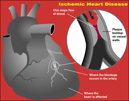 Ischemic Heart Disease