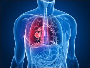 Ayurvedic Treatment of Malignant Mesothelioma