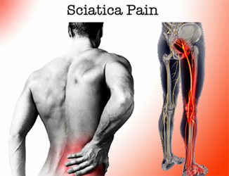 Home Remedies for Sciatica