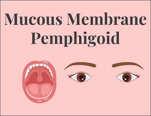 What is Mucous Membrane Pemphigoid & It’s Ayurvedic Treatment with Herbal Remedies