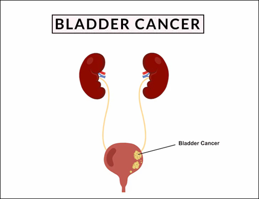 Bladder Cancer, Symptoms, Causes, Management, Ayurvedic Treatment, Herbal Remeides, Bladder Cancer with Herbal Remedies, Ayurvedic treatment for Bladder Cancer, Bladder Cancer Causes, Bladder Cancer Symptoms, What is Bladder Cancer