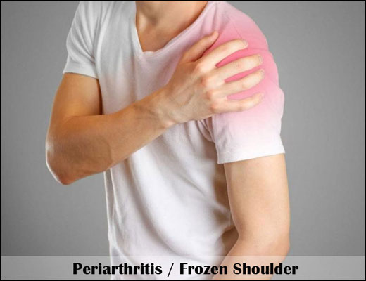 Periarthritis