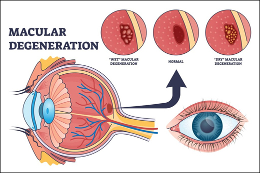 Macular Degeneration, What is Macular Degeneration, Causes of Macular Degeneration, Symptoms of Macular Degeneration, Types of Macular Degeneration, Ayurvedic View And Management, Herbal Remedies for Macular Degeneration, Ayurvedic Treatment for Macular Degeneration